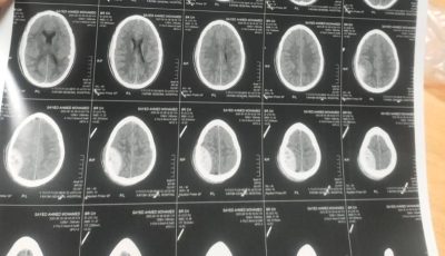 بعد توقفها عامين.. مستشفى الفيوم العام يجري جراحة مخ دقيقة لإنقاذ شاب