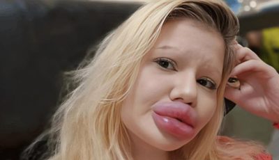 «لم أطلب الشفقة بل العلاج».. أندريا تتحدى نظرة الأطباء لشفتيها